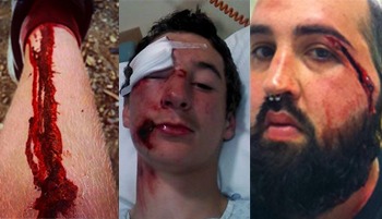Our FB Group Users' BMX Injuries